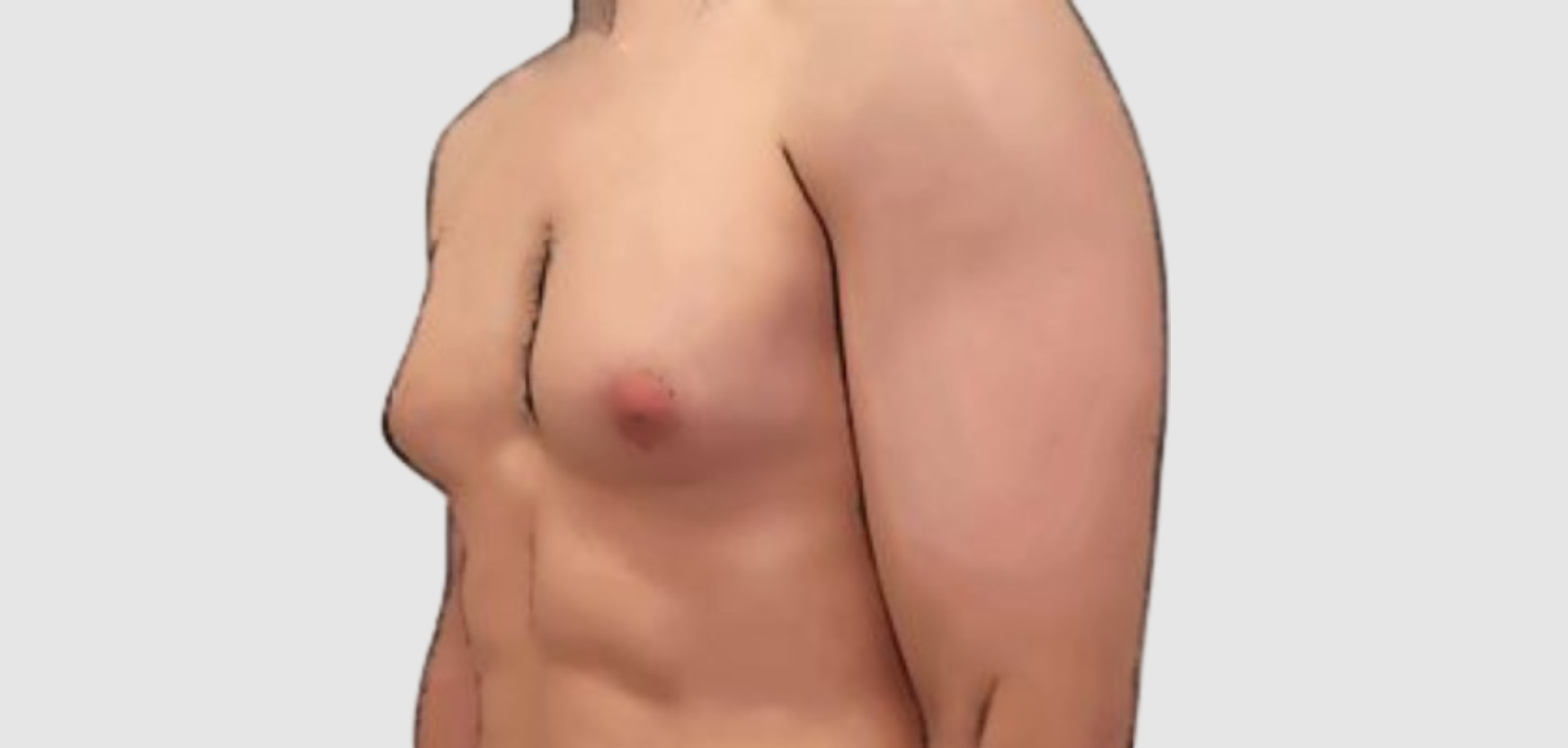 nude stages of puberty growth Breast enlargement in males Information | Mount Sinai - New York