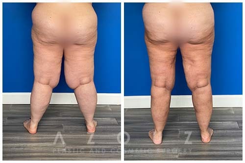 How My Lipedema Surgery Was Different From Liposuction
