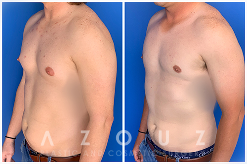 This patient desired an Areola Reduction to improve his #Confidence for the  summer! Areola Reduction surgeries offer many benefits for men and can  be