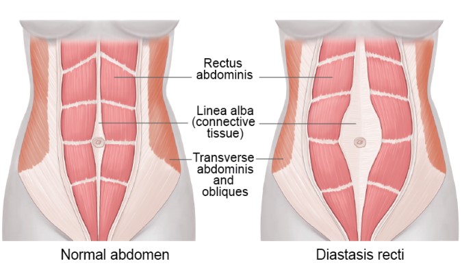 Preguntas frecuentes sobre la abdominoplastia o cirugia estetica del  abdomen