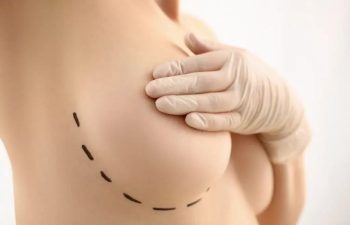 XL Breast Augmentation Dallas Before & After