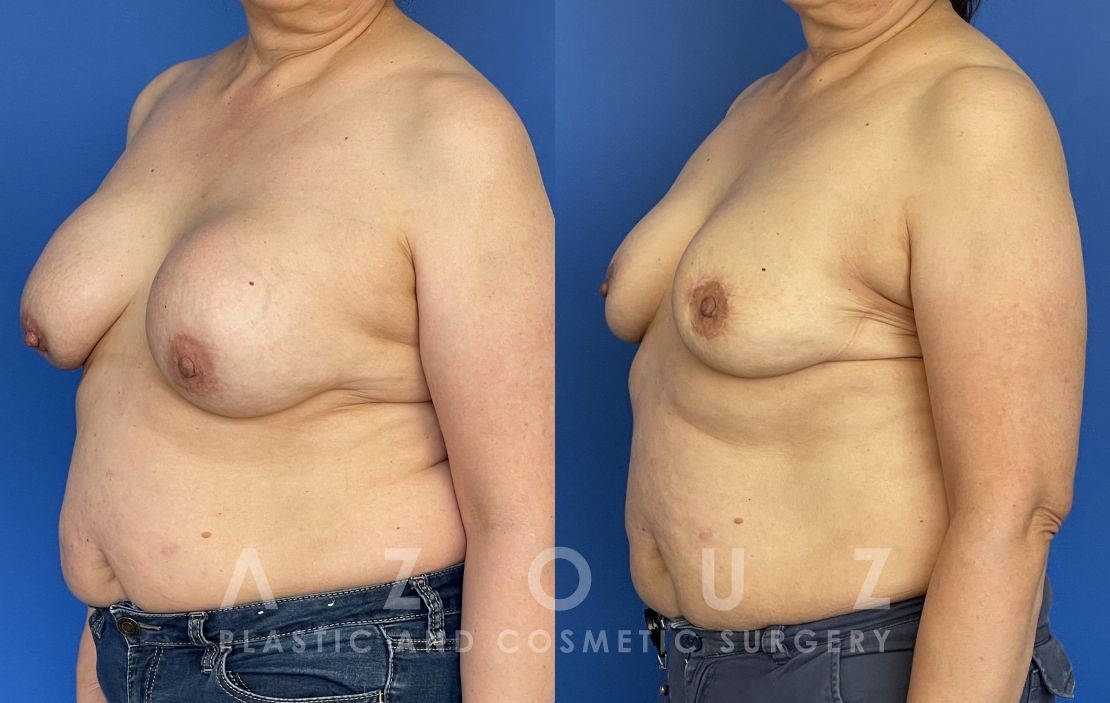 Breast Implant Removal Without Replacement For Patients With