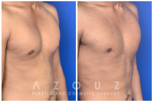 Teen Gynecomastia patient before and after treatment