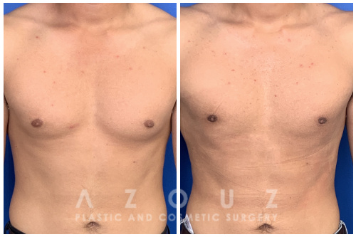 🥇 Will Gynecomastia Go Away Naturally or On It's Own?