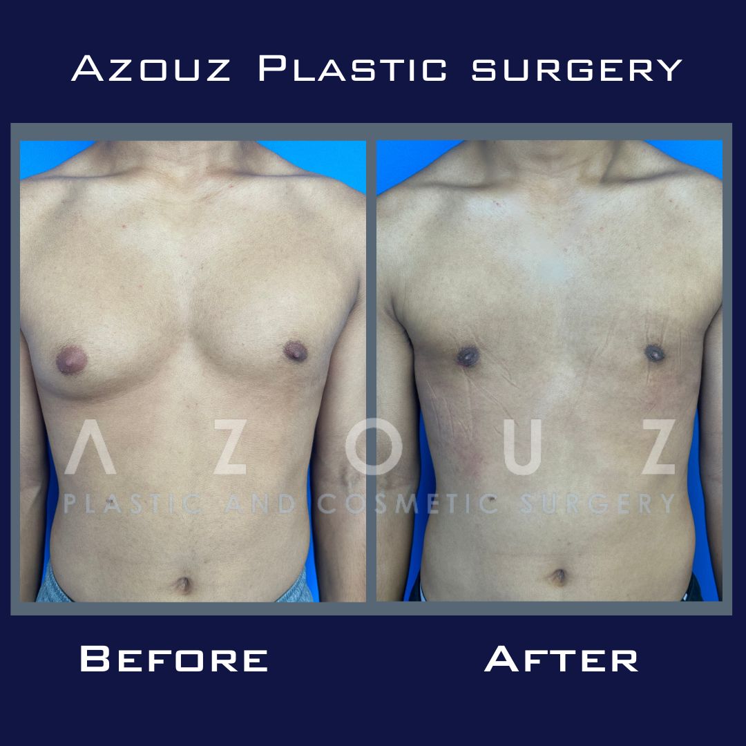 Uneven Breasts  Surgery for Breast Asymmetry by Tucson Plastic Surgeon