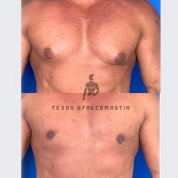 🥇 Dallas TX Gynecomastia  Plano Male Breast Reduction Surgery
