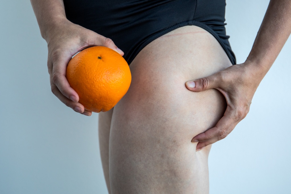 🥇 Dallas TX Lipedema Treatment  Plano Lipedema Leg Fat Removal
