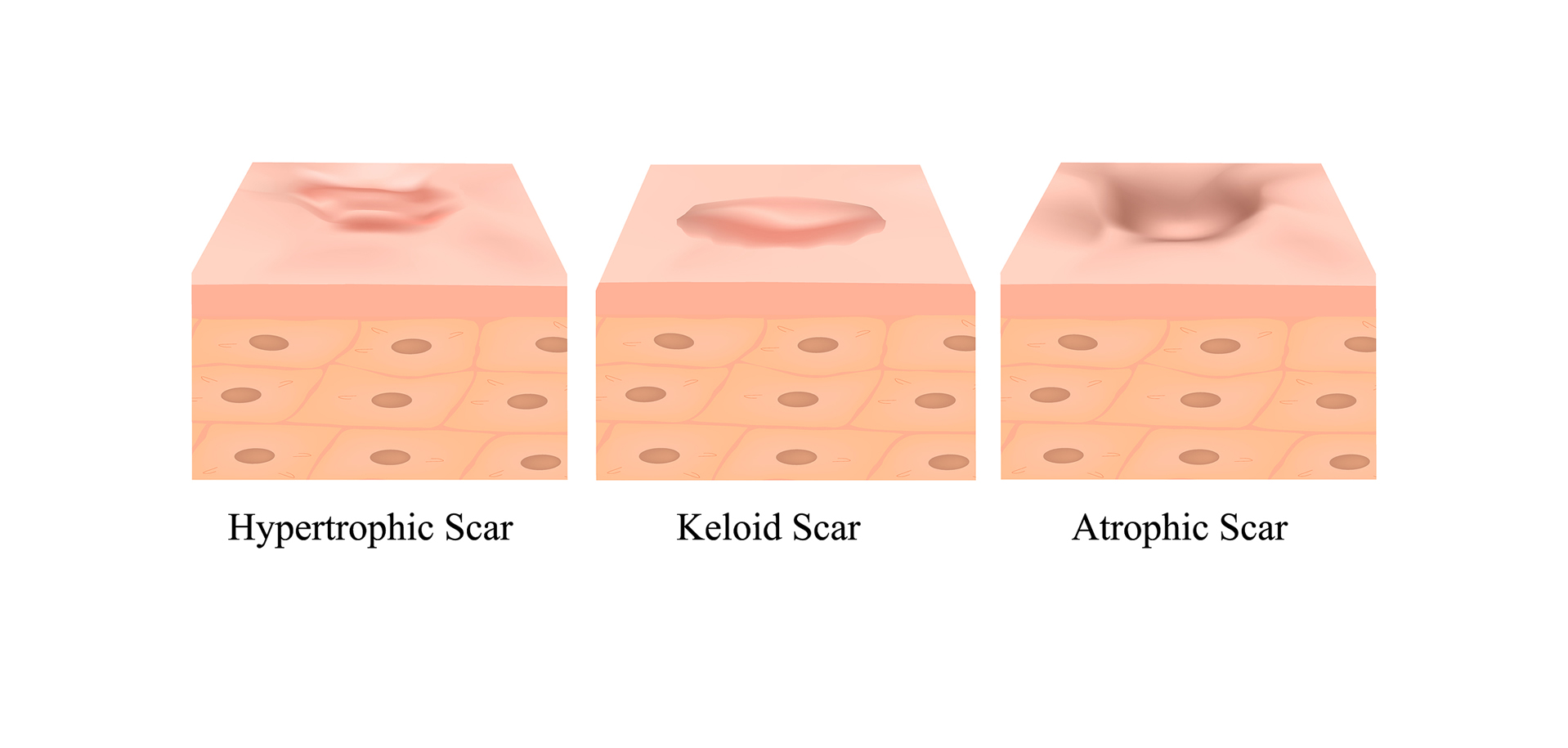 🥇 Dallas TX C Section Scar Removal, Plano C-Section Scar Treatment