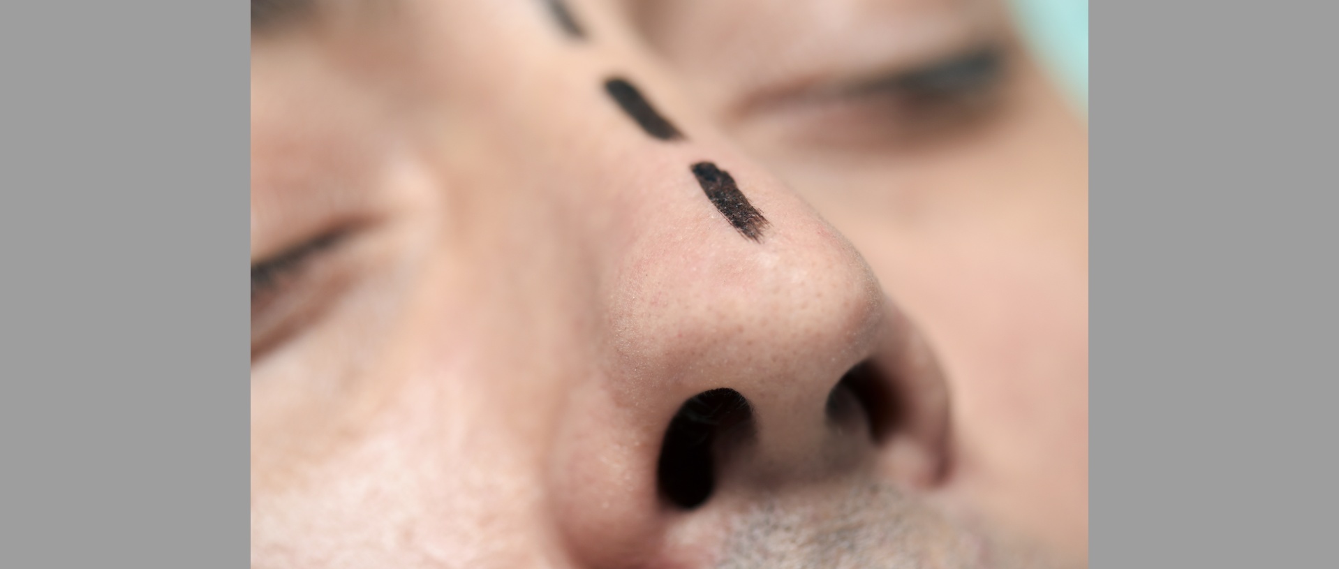 man with surgery lines marked in his nose | Nasal Reconstruction