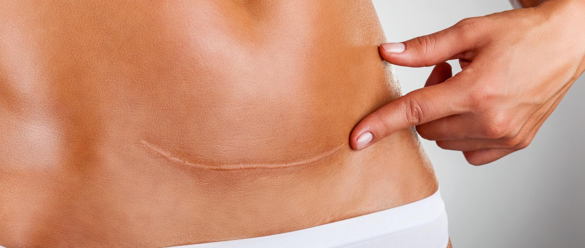 vientre de mujer con una cicatriz de una cesárea | eliminación y revisión de cicatrices