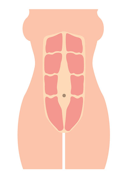 diastatis around navel