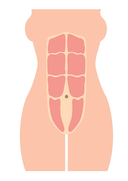 diastatis below navel