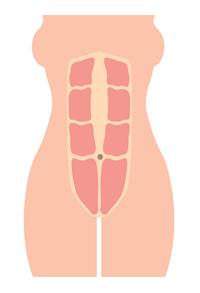 diastatis above navel
