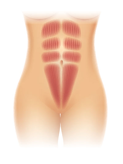 diastasis recti | abdominal separation