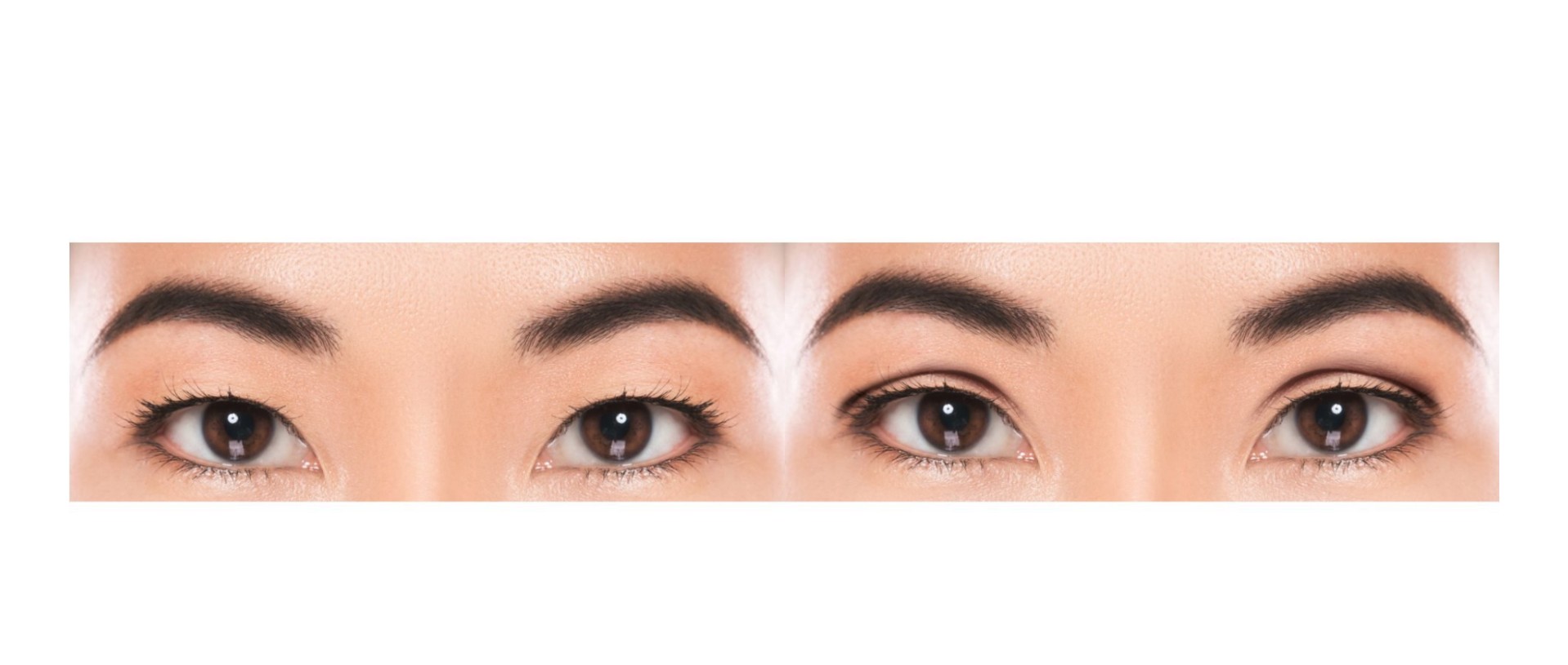 Asian eyelid surgery blepharoplasty before and after
