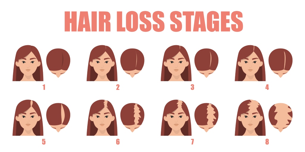 female balding patterns | hair loss patterns in women