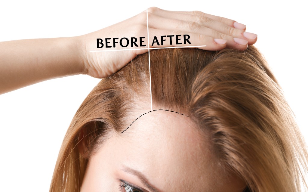 tratamiento para la caída del cabello antes y después.
