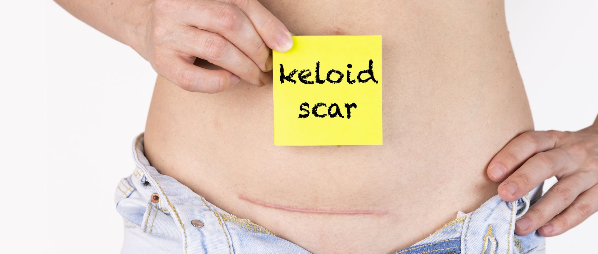 keloid scar treatment