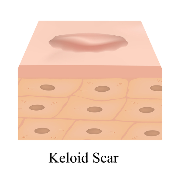 keloid scar