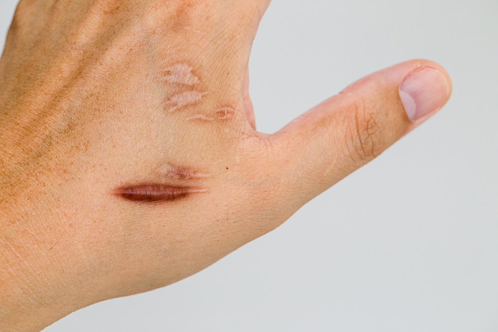 keloid scar removal