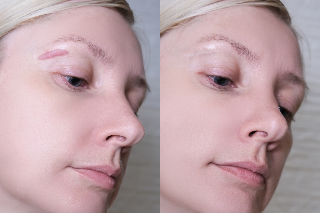 cirugía de eliminación de cicatrices queloides antes y después