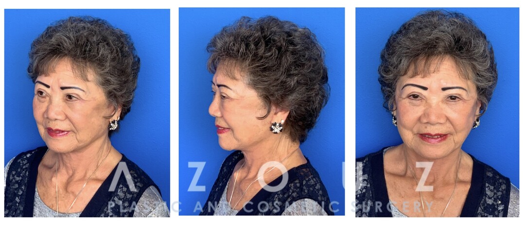 antes y después de la cirugía de párpados por el Dr. Solomon Azouz en Dallas