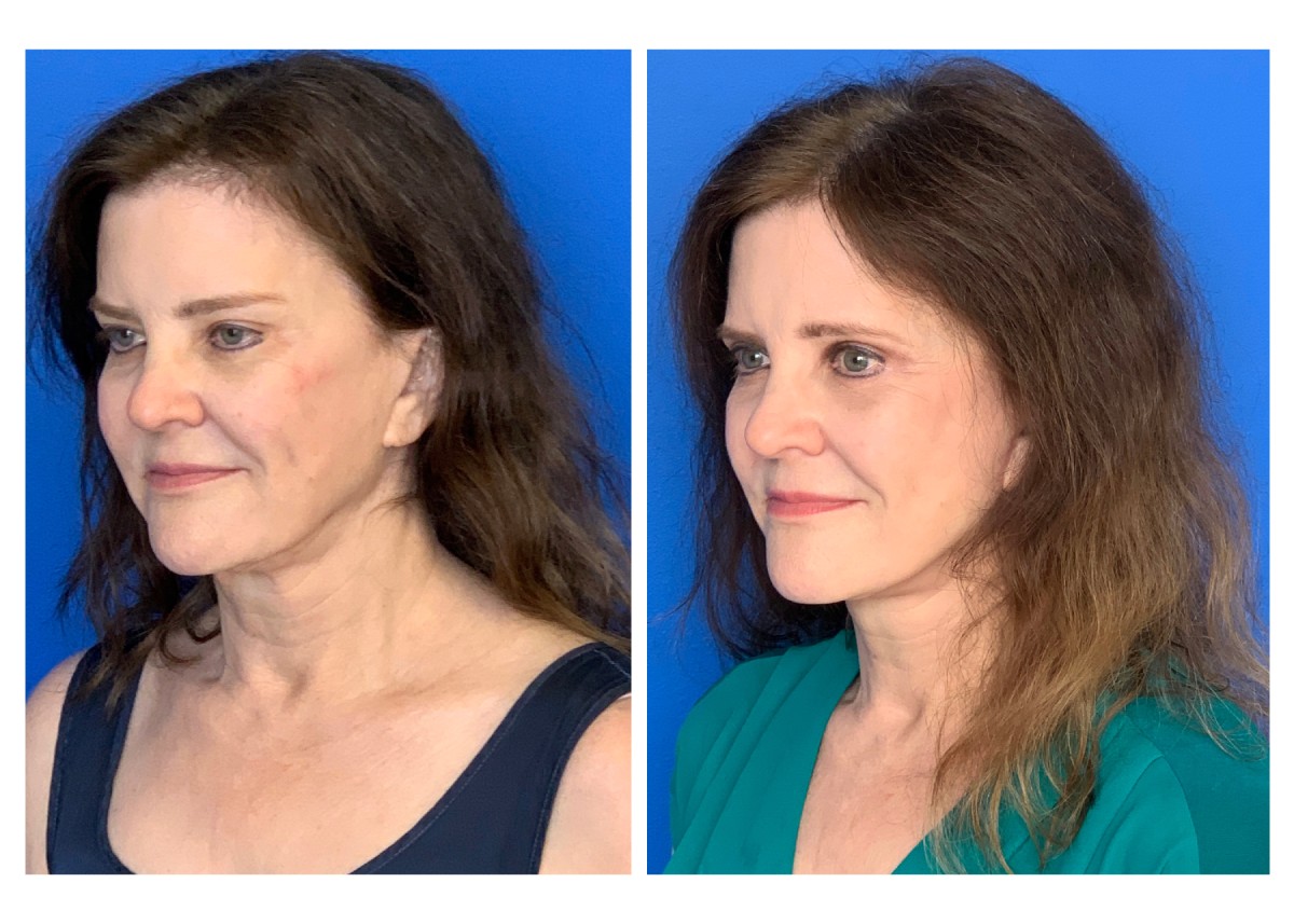 eyelid surgery before and after by Dr. Solomon Azouz in Dallas, TX