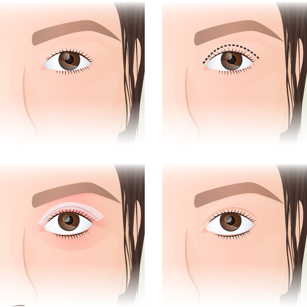 Asian blepharoplasty before and after