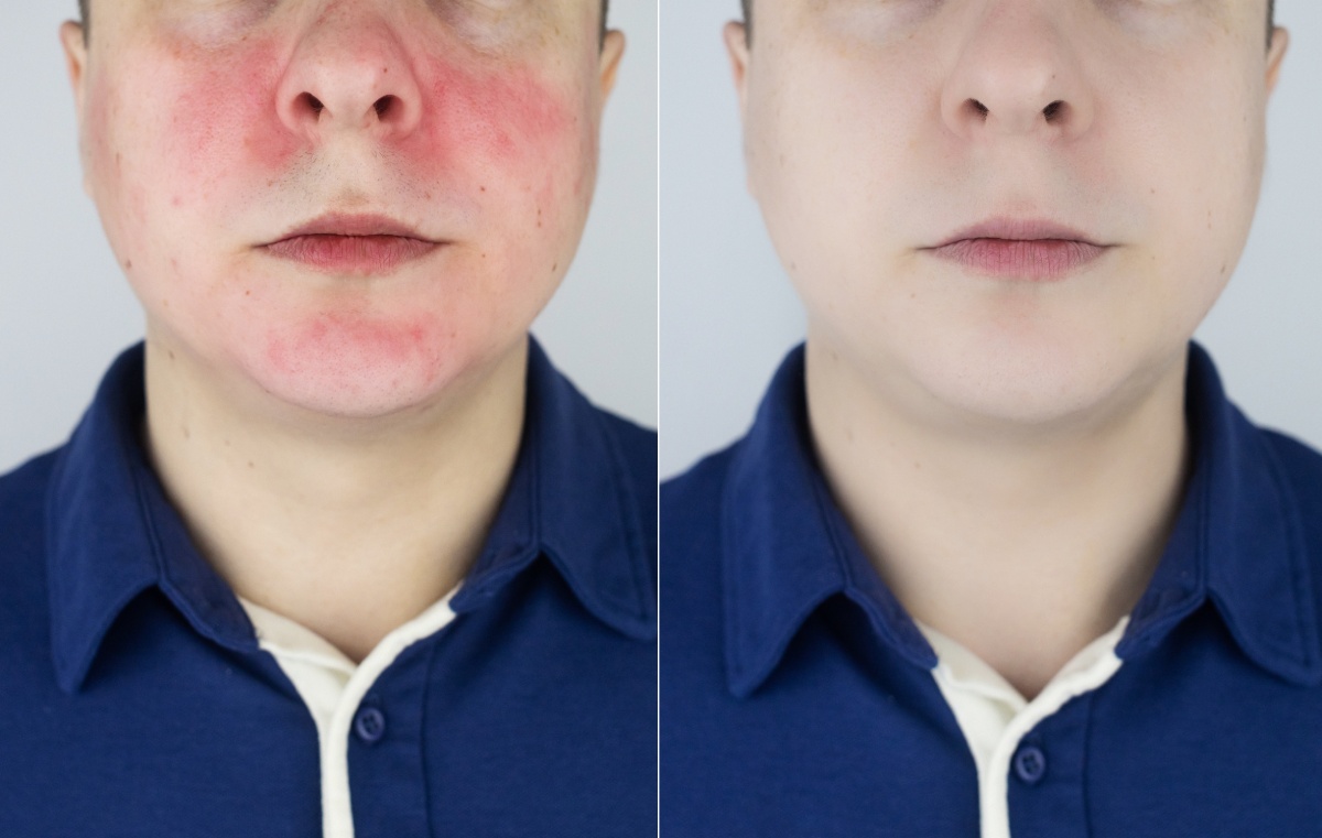 rosacea before and after laser resurfacing