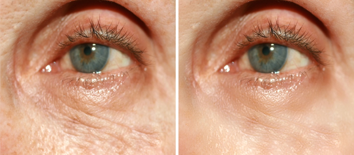 rejuvenecimiento con láser debajo de los ojos antes y después