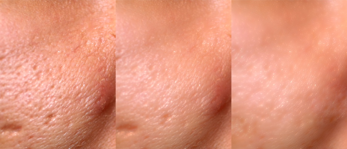 cicatrices de acné antes y después del rejuvenecimiento con láser
