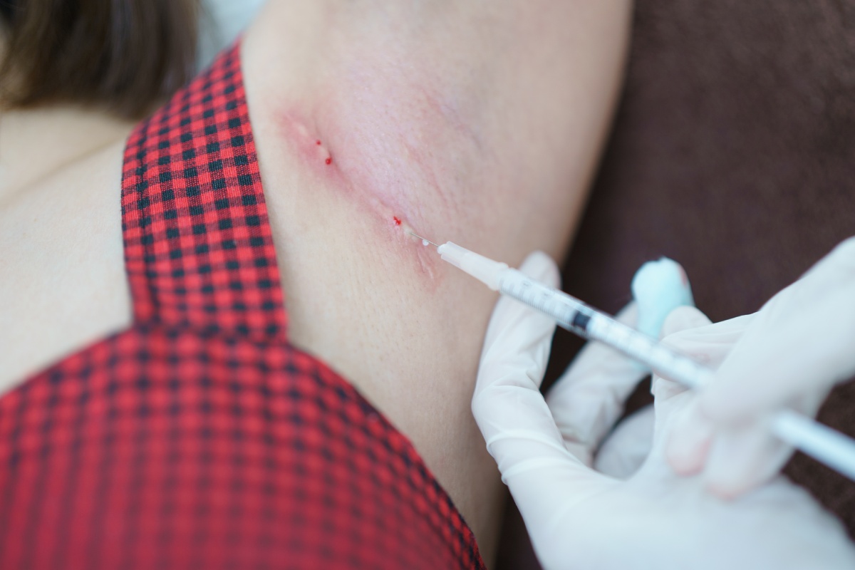 Kenalog injection for keloid remova