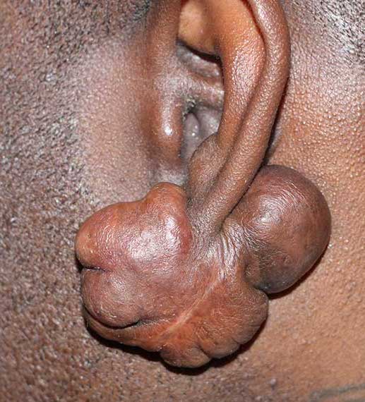 queloide en perforación de oreja
