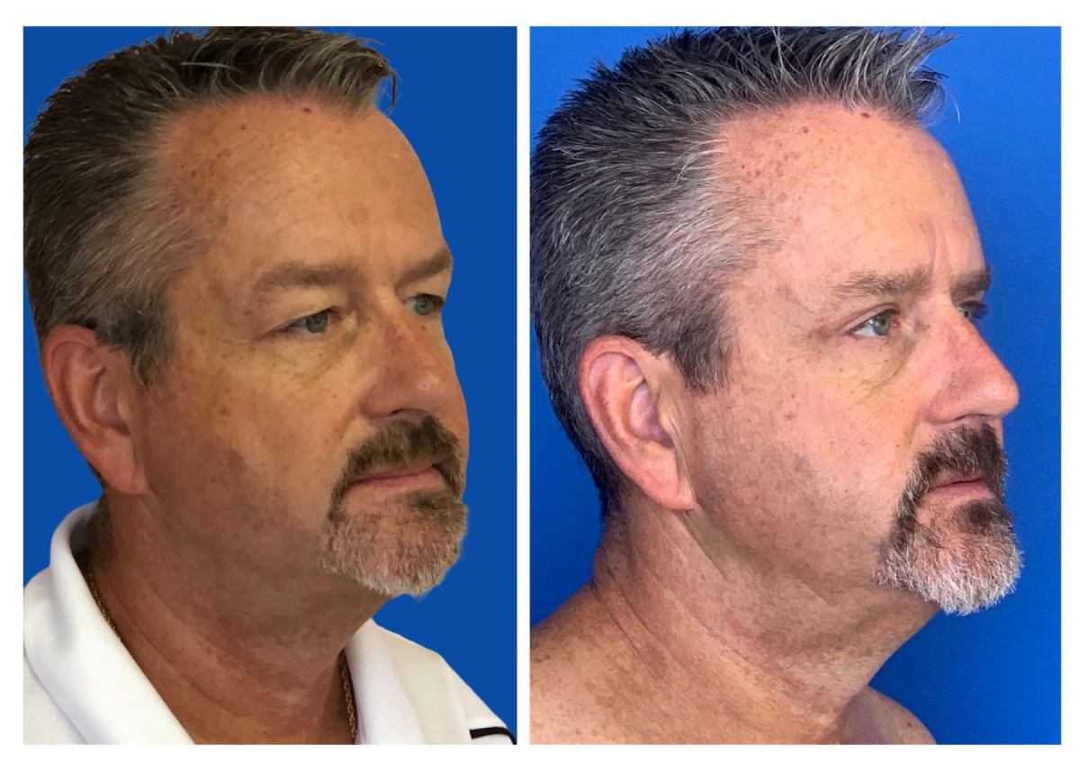 cirugía de párpados antes y después por el Dr. Solomon Azouz en Dallas, TX