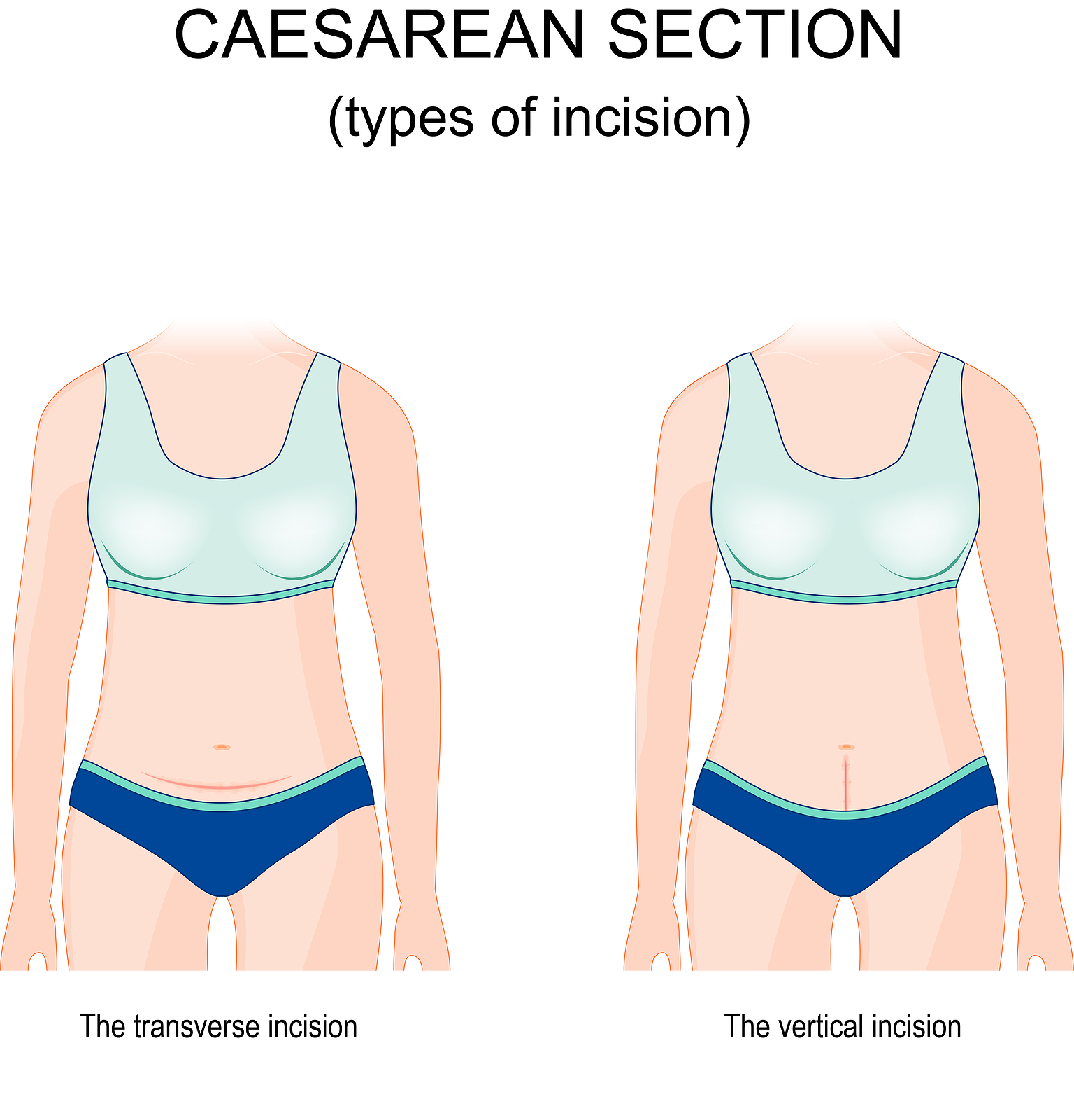 types of c-section scars