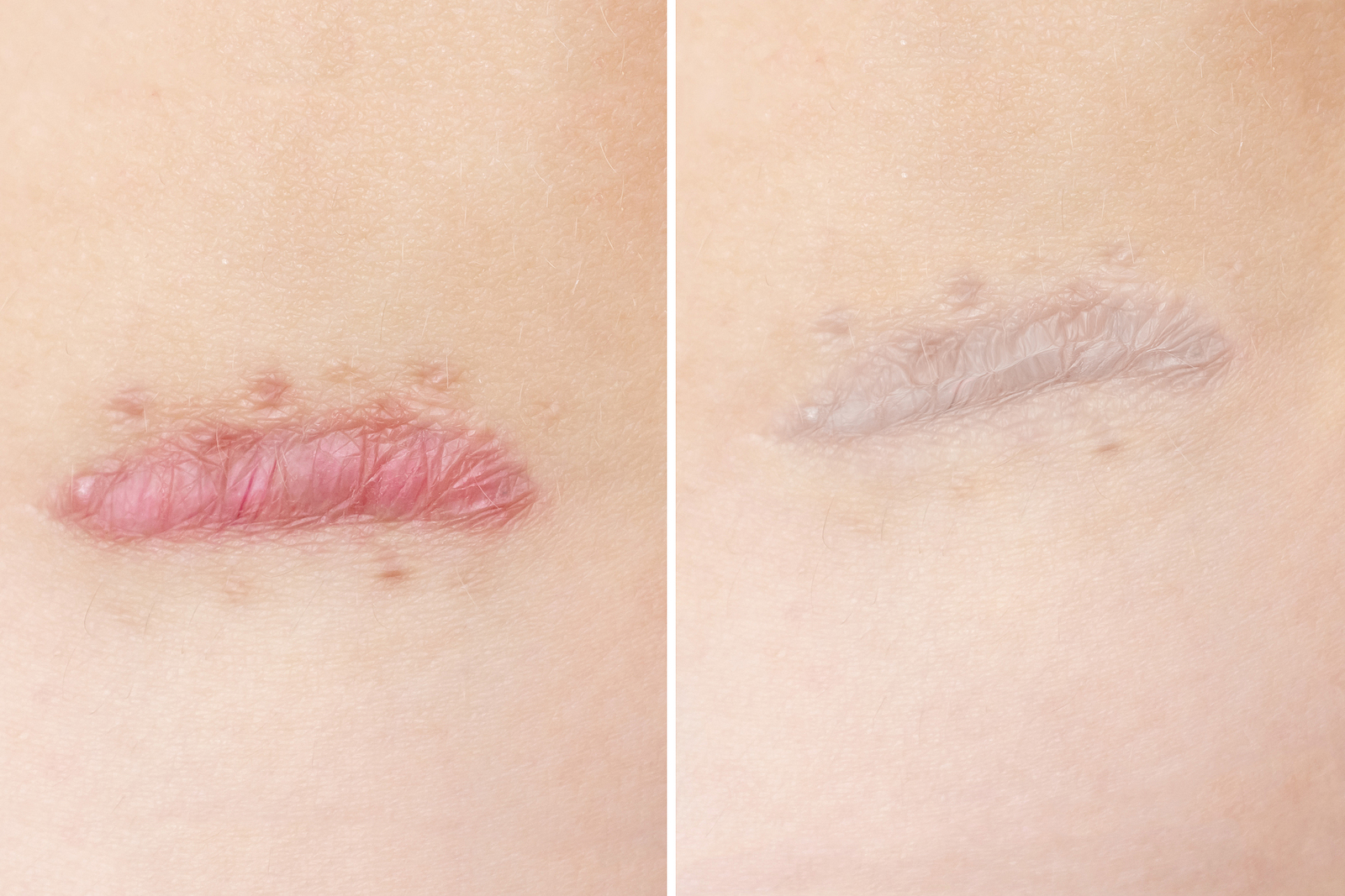 Antes y después de la eliminación de cicatrices hipertróficas
