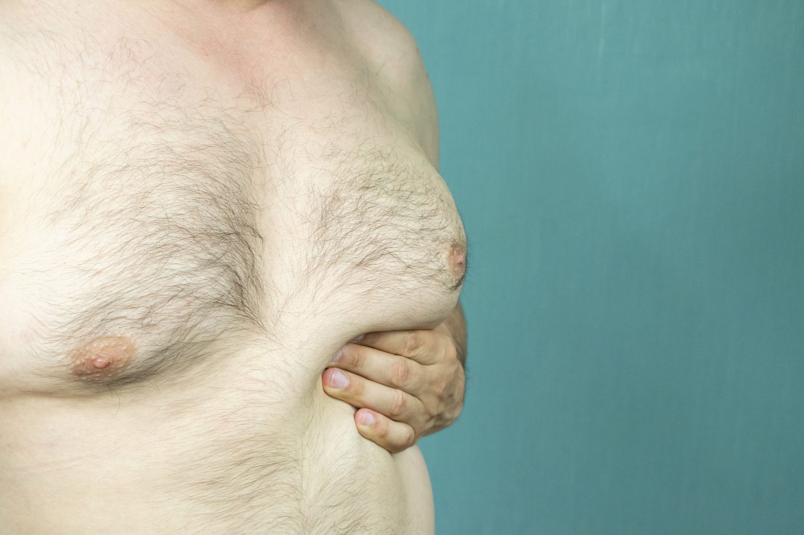 gynecomastia vs chest fat