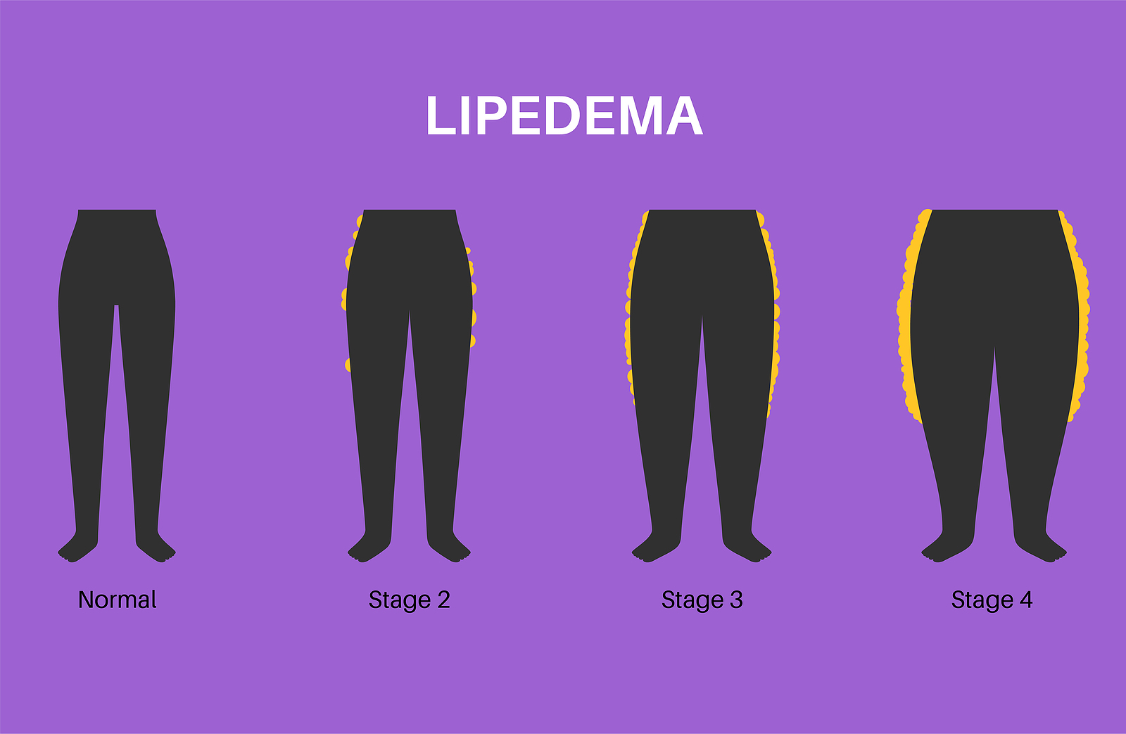 stages of lipedema