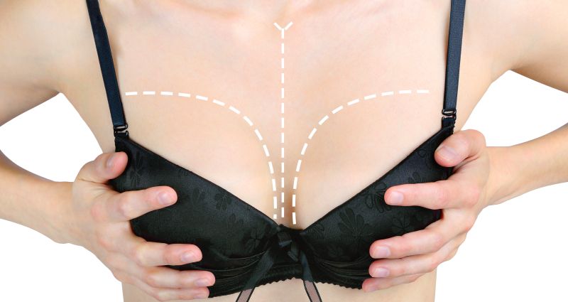 Marks on woman's breasts before cosmetic surgery