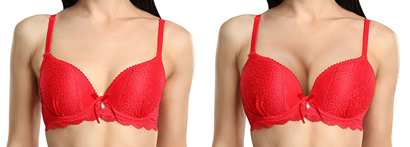 breast augmentation before and after