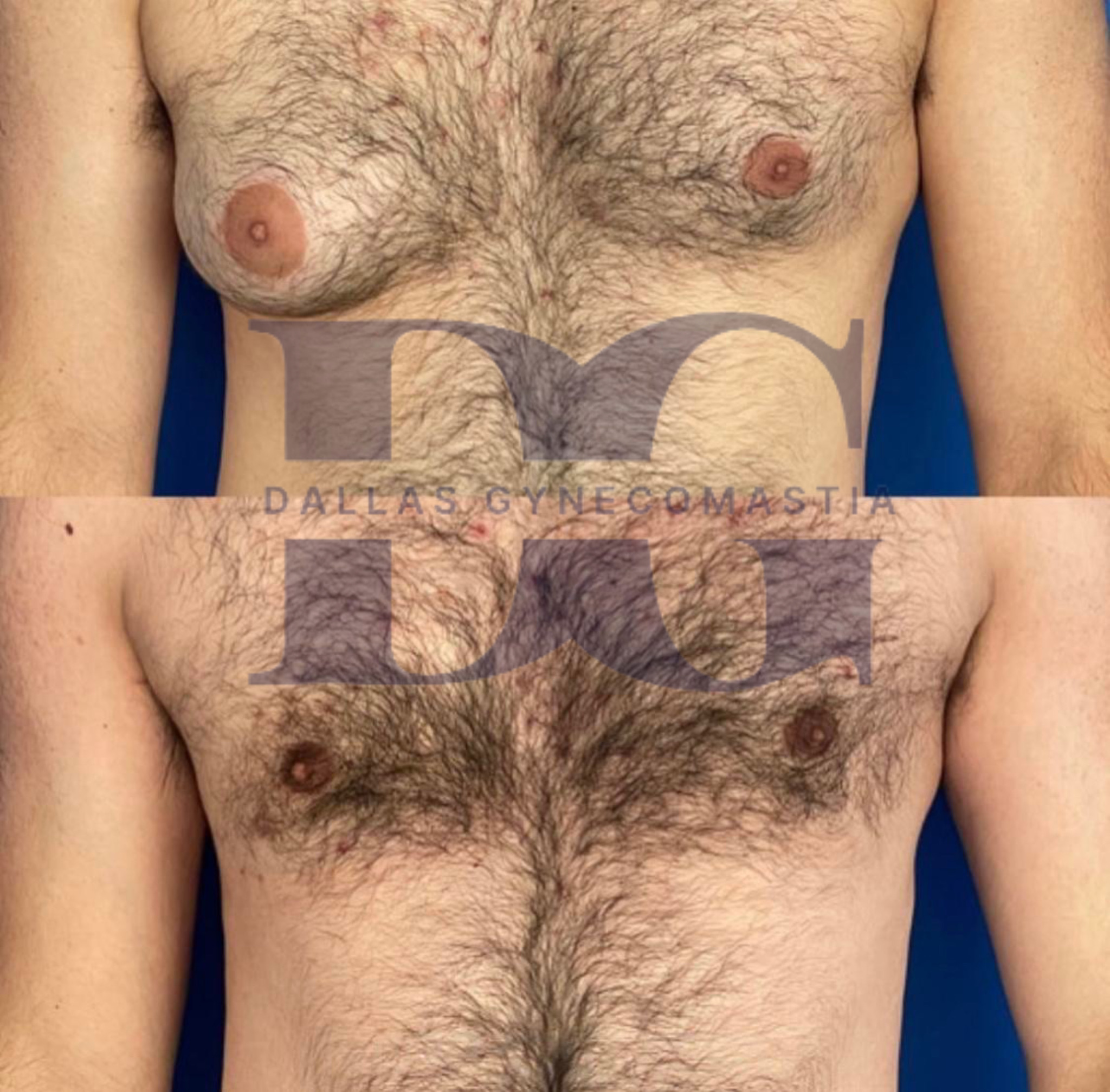 gynecomastia before and after by Dr. Solomon Azouz