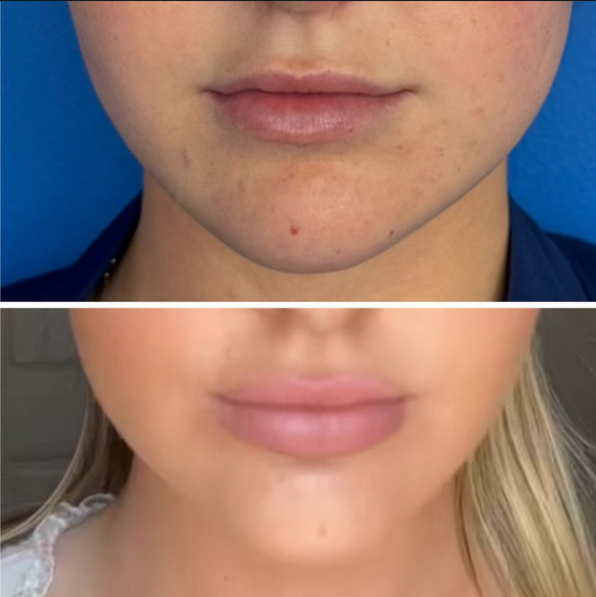 antes y después de lip flip por Dr. Solomon Azouz en Dallas, TX