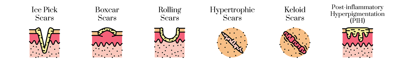 tipos de cicatrices de acné