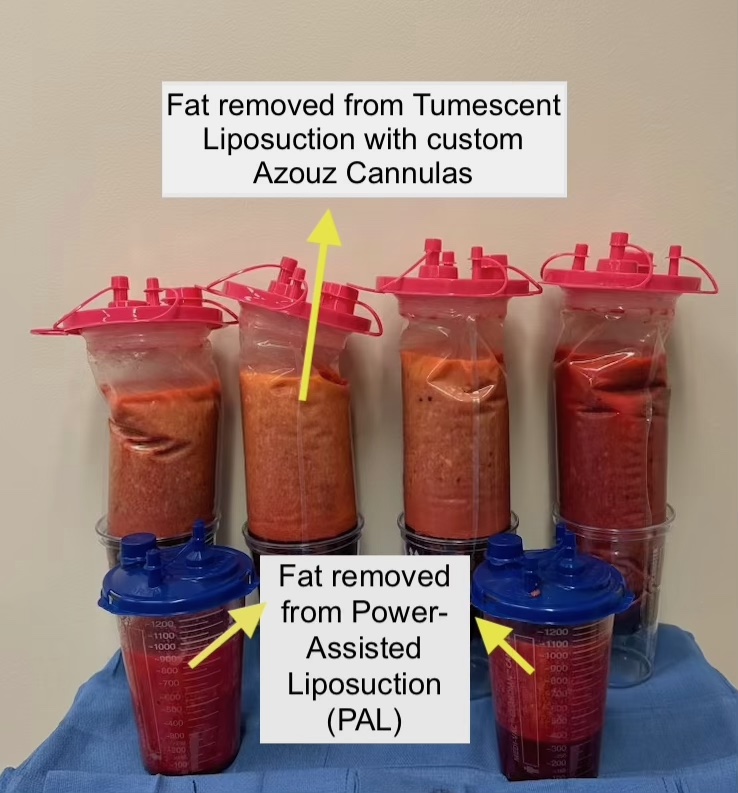 PAL vs liposucción tumescente por Dr. Solomon Azouz