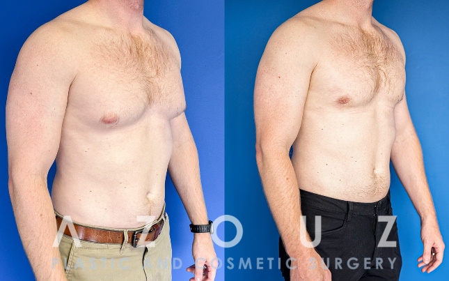 gynecomastia surgery before and after by Dr. Solomon Azouz in Dallas, Texas