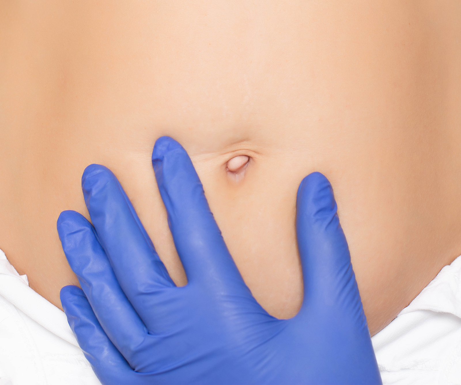 umbilicoplasty belly button surgery