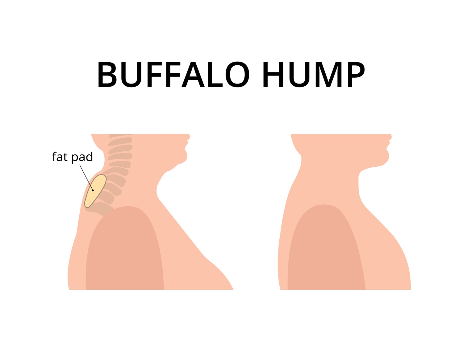 buffalo neck hump treatment before and after