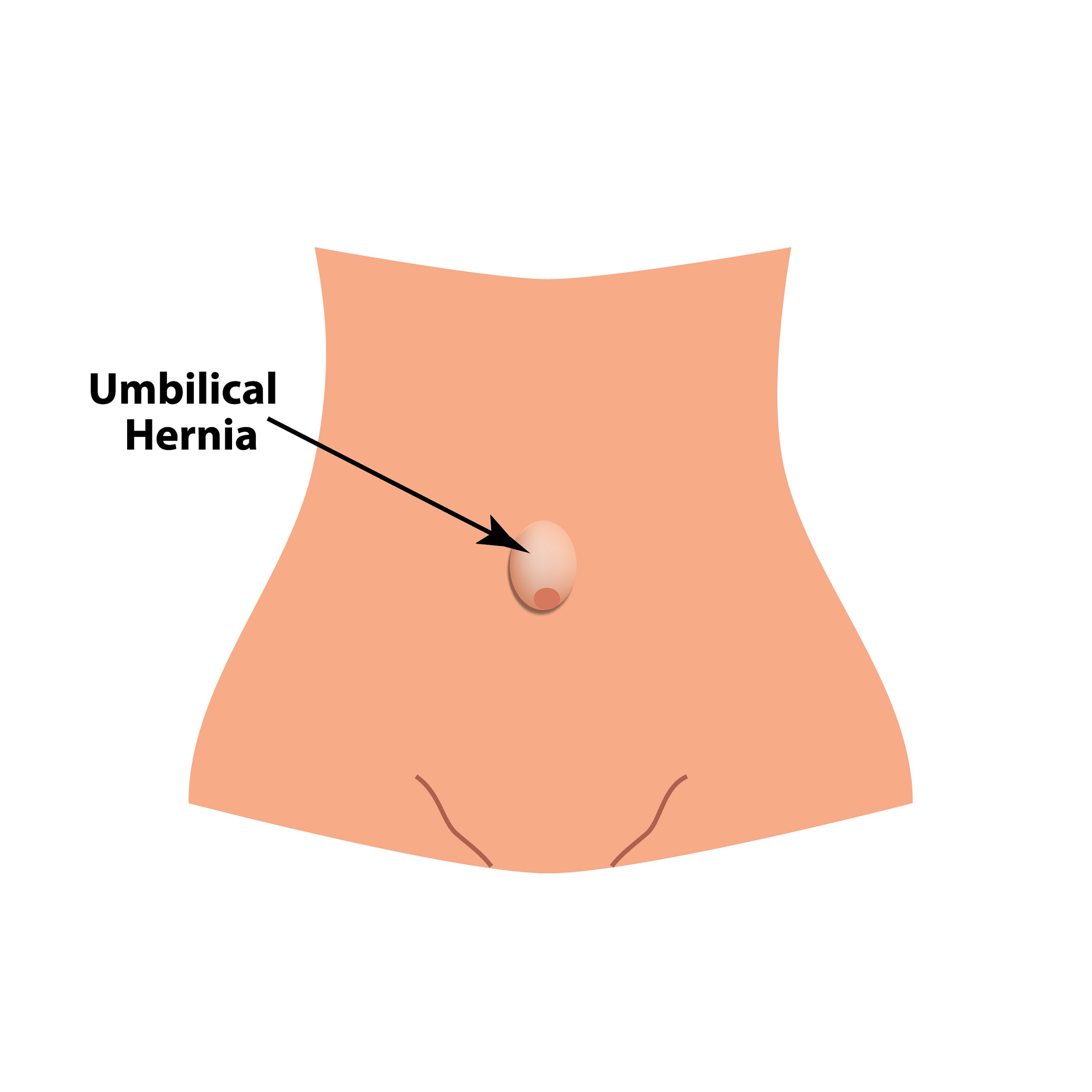 umbilical hernia surgery