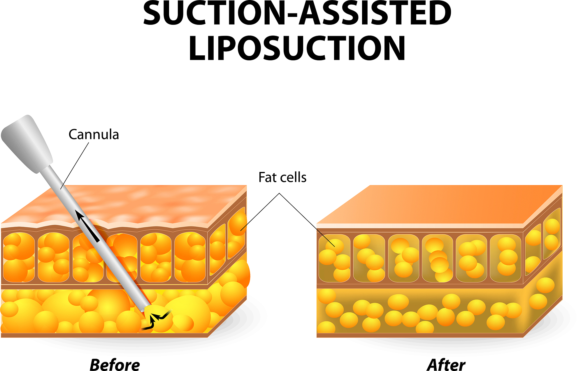 liposuction fat removal