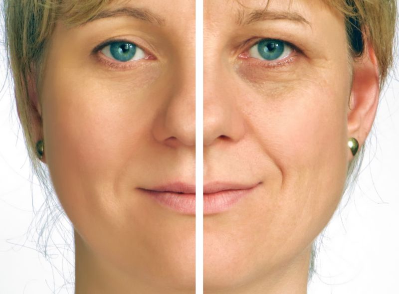 mature woman's face before and after facial fat grafting